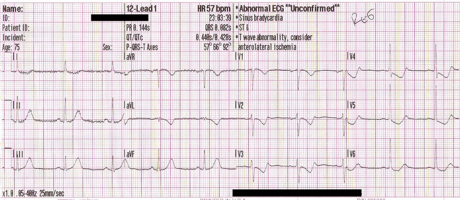 re ekg rhythm strip Re ekg rhythm strip
